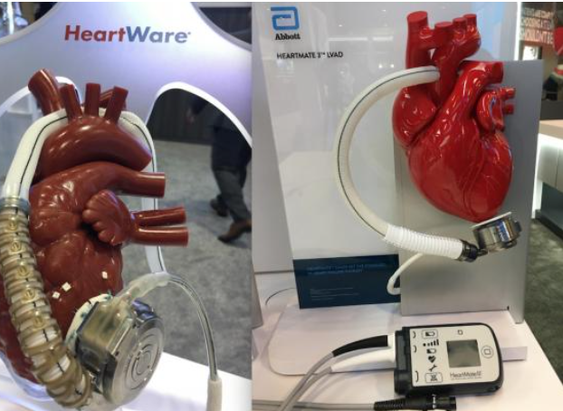 What Happens If LVAD Battery Dies? | Battery Tools